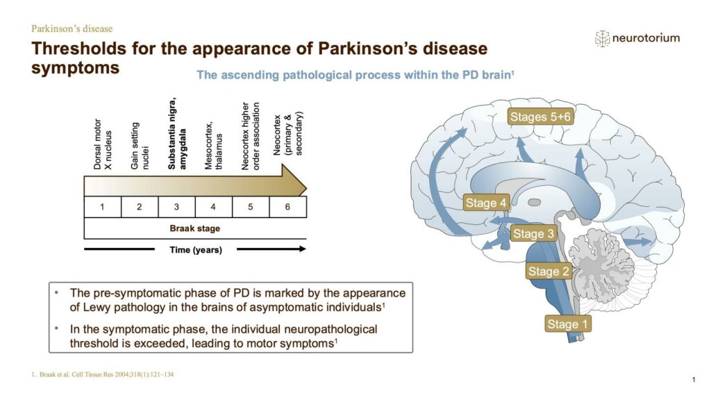 Thresholds for the appearance of Parkinson’s disease symptoms